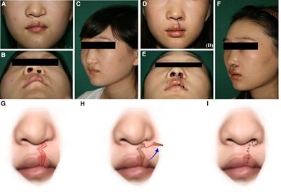 Correction of narrow nostril deformity secondary to cleft lip: indications for different surgical methods and a retrospective study